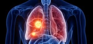 Read more about the article Advancing Lung Cancer Screening: European Initiatives and AI Integration